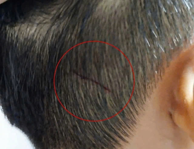 Bé Đ.N.A.K bị đánh chảy máu ở vùng đầu