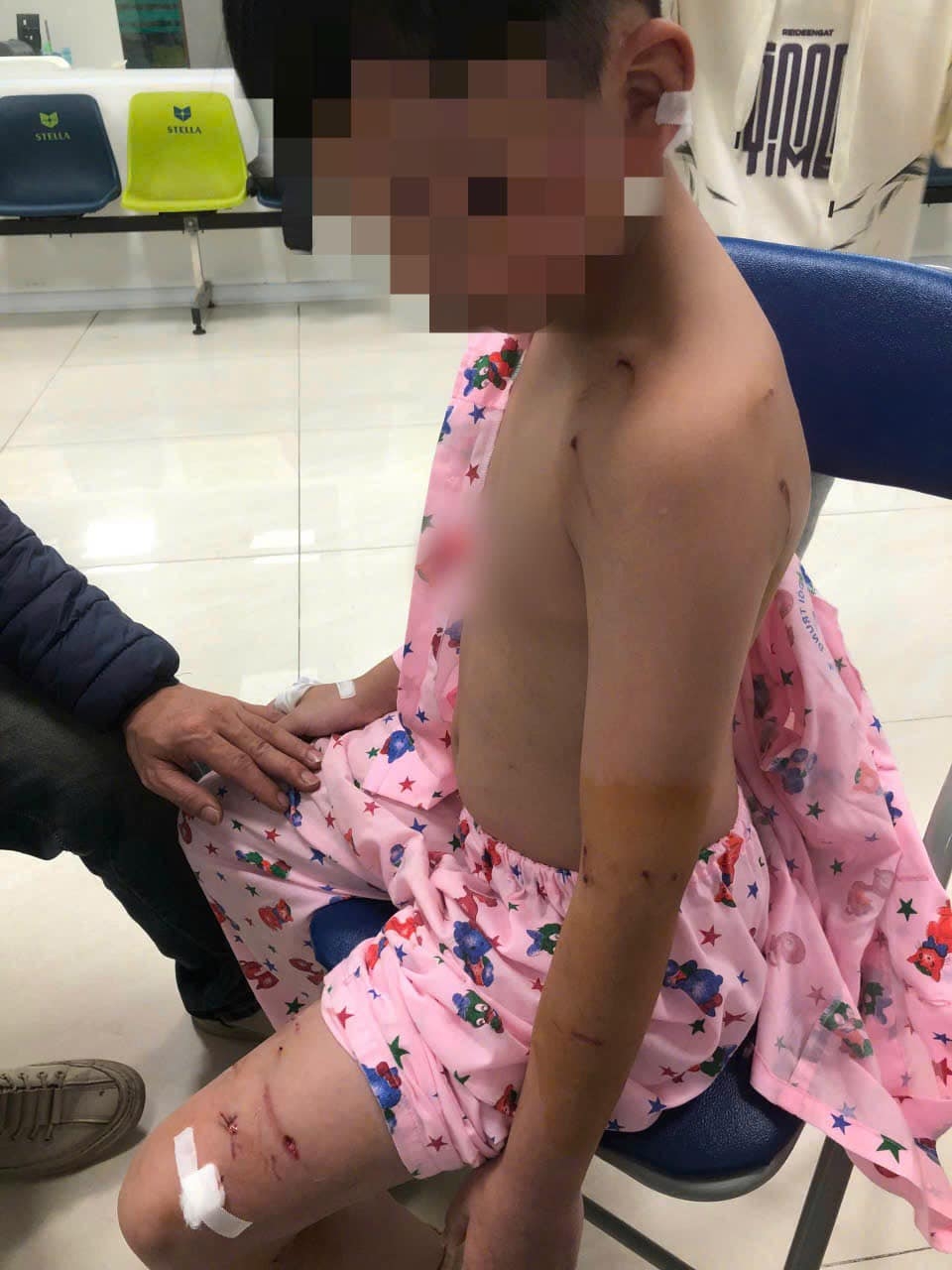 Bị chó tấn công khi đi chúc Tết, bé trai phải khâu 9 mũi