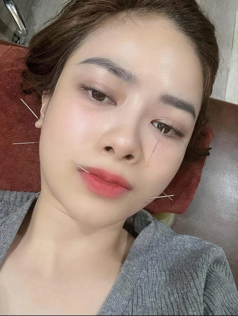 Dương Hoàng Yến châm cứu vì bị liệt dây thần kinh số 7 ngoại biên.