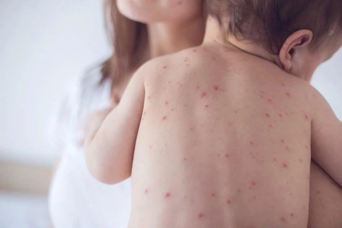 Tuần qua, Hà Nội ghi nhận 182 trường hợp mắc sởi, trong đó có 1 ca tử vong
