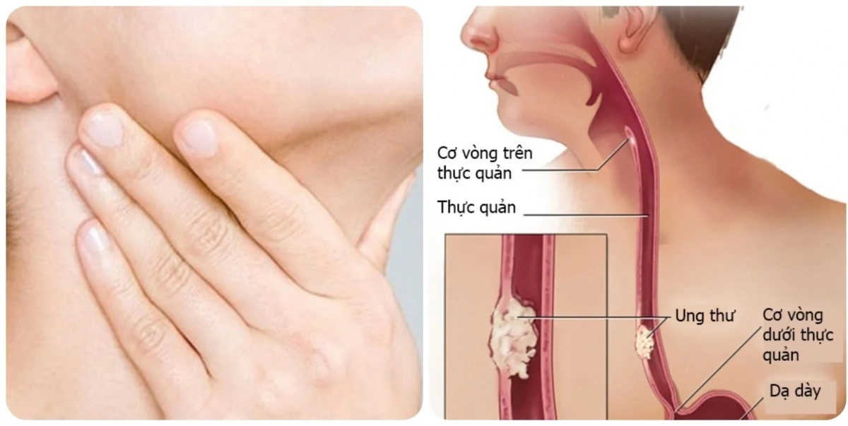 Ung thư thực quản là căn bệnh ung thư phổ biến.