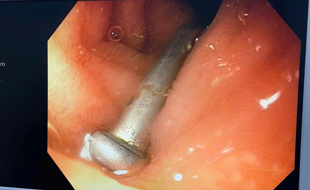 Hỉnh ảnh dị vật là chiếc đinh 3 cm trong đường tiêu hóa bệnh nhi