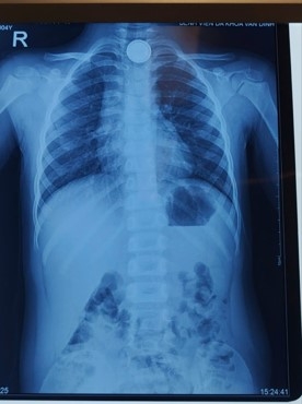 Dị vật mắc ở thực quản ngang mức xương đòn của bệnh nhi 4 tuổi