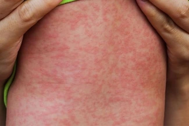 Triệu chứng nổi ban đỏ điển hình của bệnh sởi