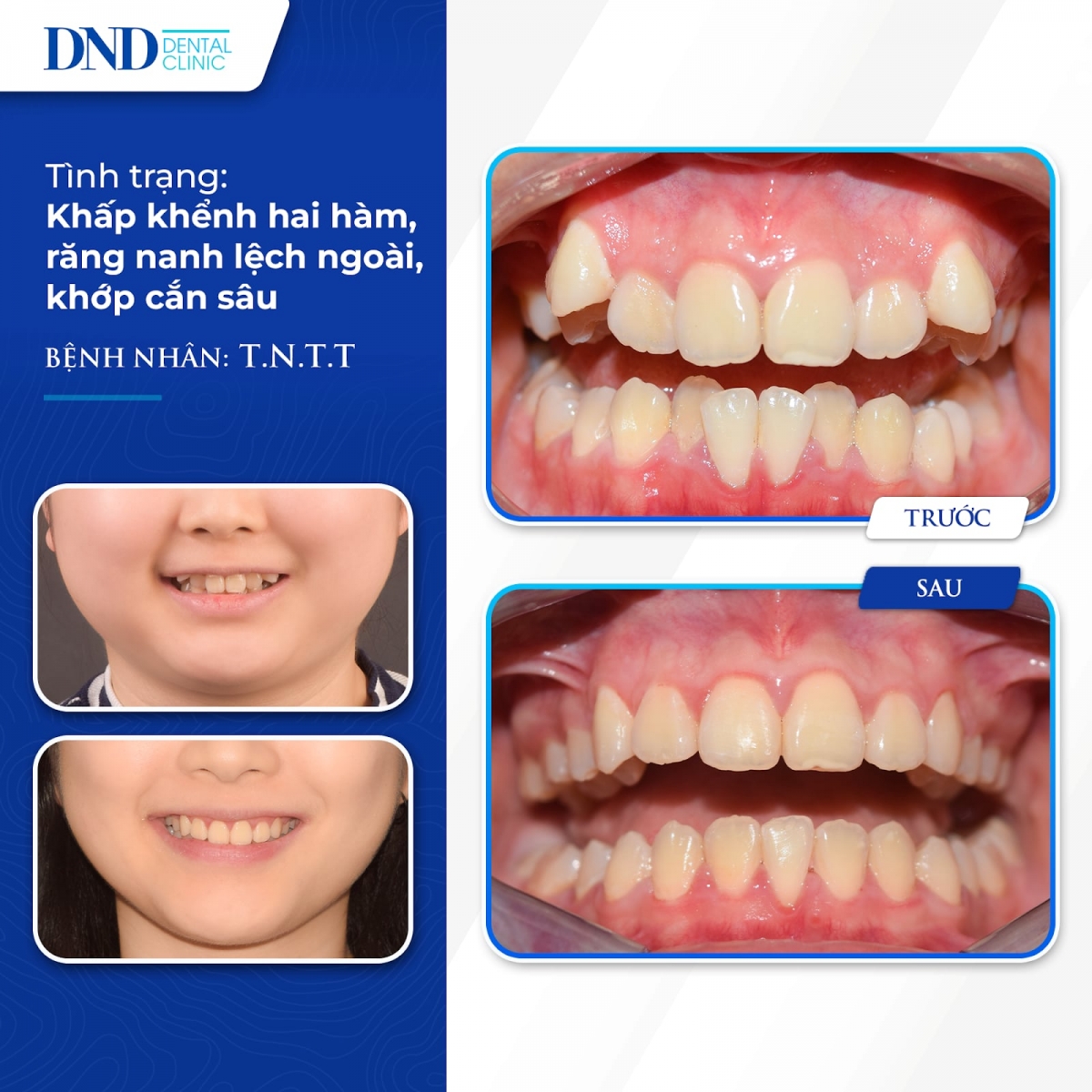 Trường hợp thực tế ca khấp khểnh, răng nanh lệch ngoài, khớp cắn sâu sau 1 năm 7 tháng với Invisalign