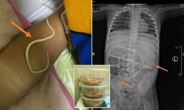 Cậu bé 3 tuổi tắc ruột vì giun làm ổ trong bụng. Ảnh: Daily Mail