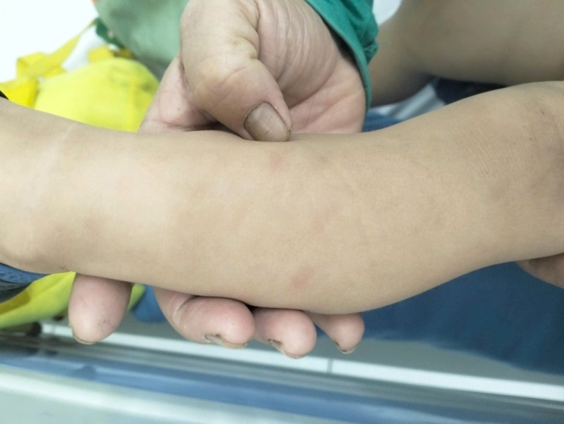 Các vết bầm trên cánh tay của trẻ.
