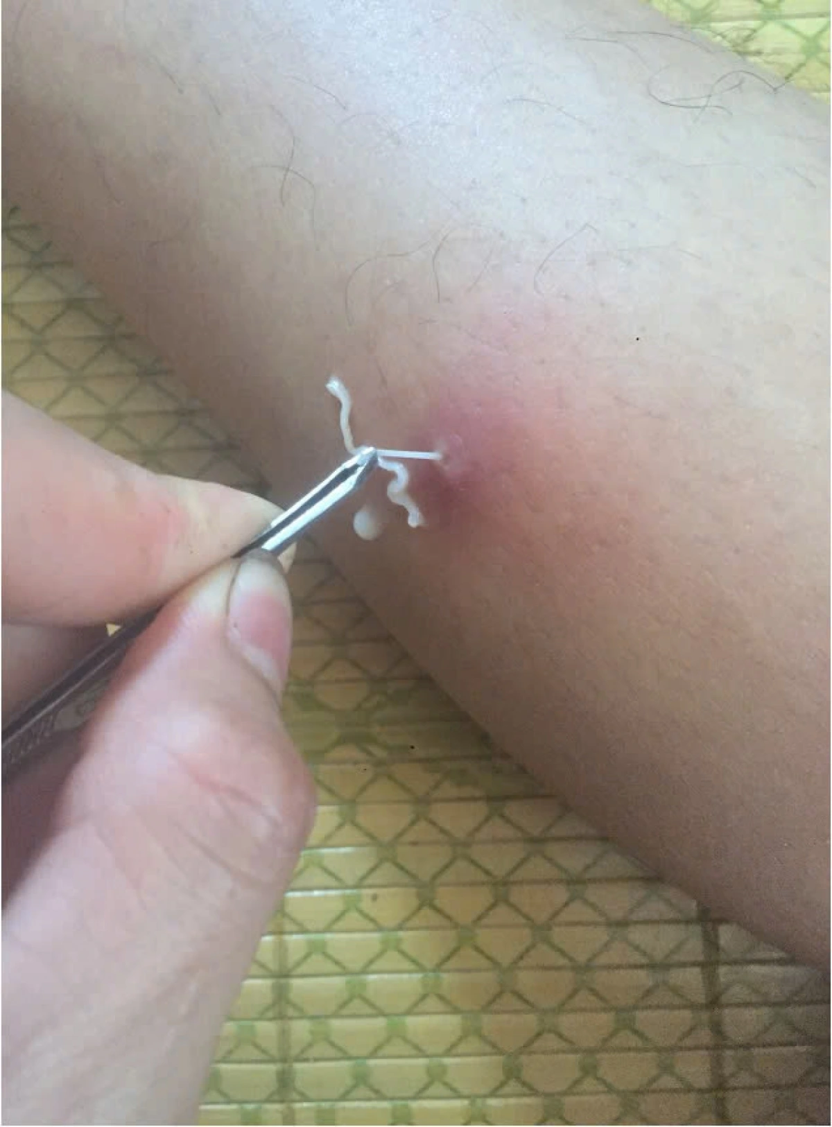 Hình ảnh gắp "giun rồng" từ chân người bệnh. (Ảnh bác sỹ cung cấp)
