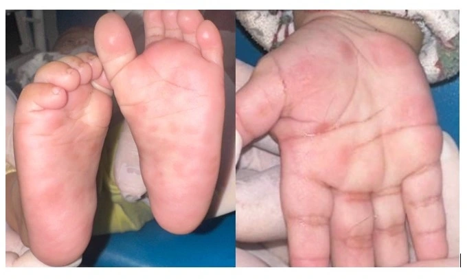 Bệnh nhi 4 tháng tuổi xuất hiện ban đỏ rải rác lòng bàn tay, bàn chân (Ảnh BVCC)