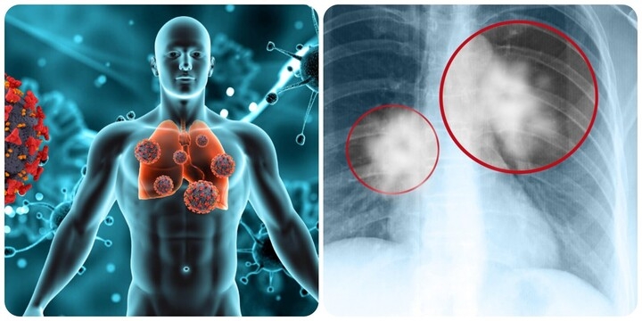 Ung thư phổi là một trong những căn bệnh ung thư nguy hiểm gây tử vong hàng đầu