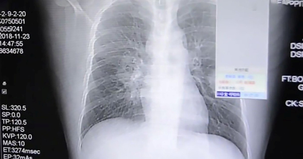 Người đàn ông nhập viện vì nhiễm trùng phổi. Ảnh minh họa: Science Alert