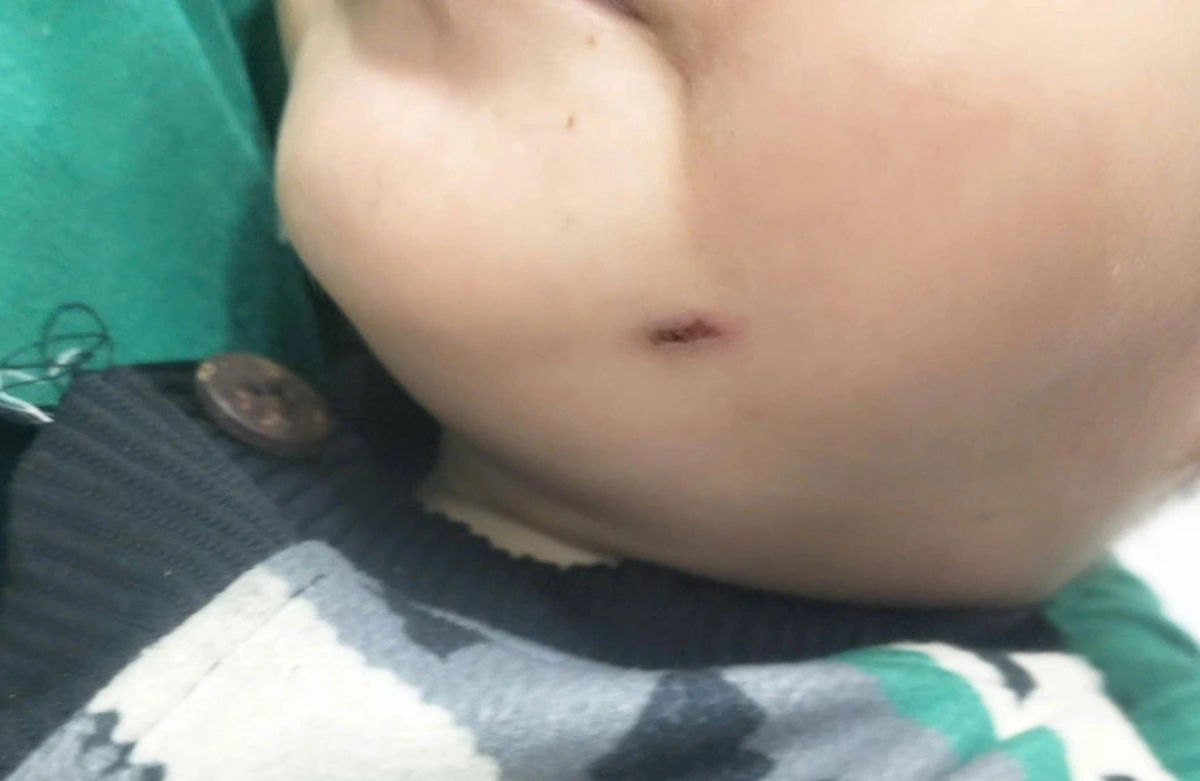 Thương tích nghi ngờ do bị đánh ở trường