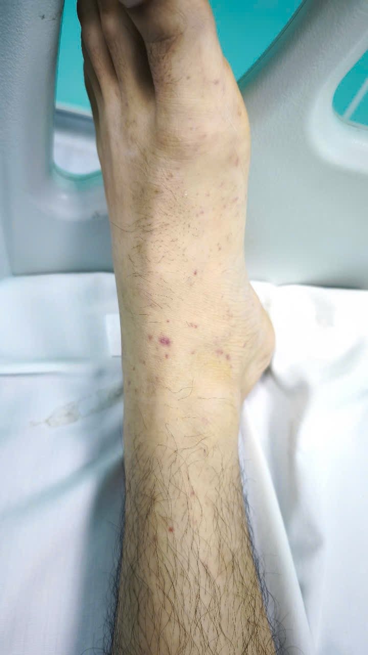 Xuất hiện ban xuất huyết rải rác trên da
