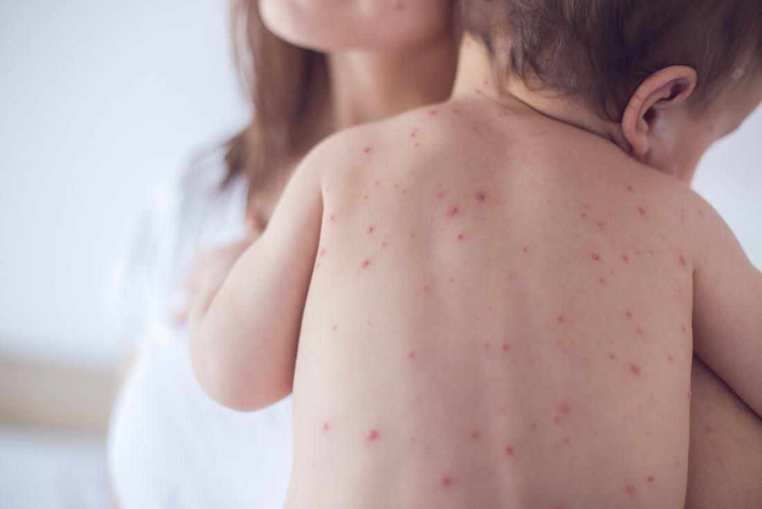 Nếu trong điều kiện không có biến chứng, các bậc phụ huynh có thể dễ dàng chăm sóc trẻ mắc sởi tại nhà