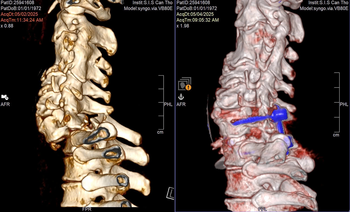 Chụp cộng hưởng từ (MRI) cột sống cổ để đánh giá mức độ và các nguyên nhân khác gây chèn ép tủy bệnh nhân