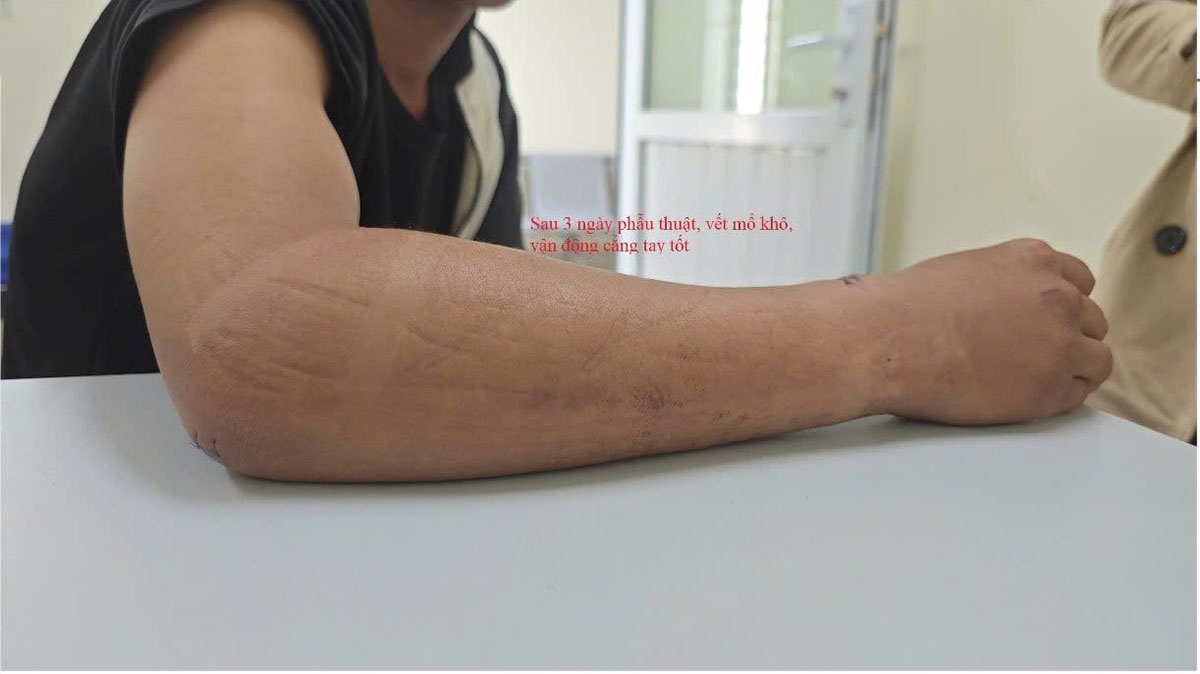 Vết mổ nhỏ, không mở vào ổ gãy, cố định xương vững chắc, giảm thiểu nguy cơ tổn thương cơ – mạch – thần kinh như trong mổ mở.