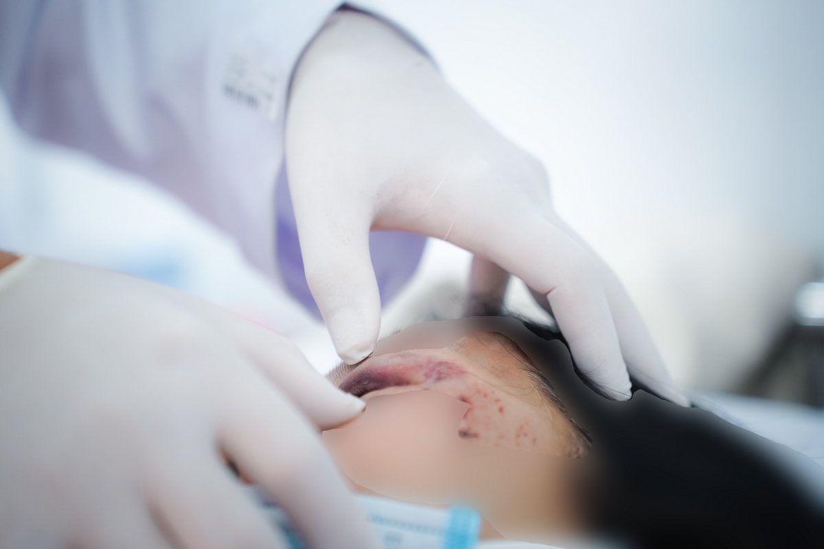 Bệnh nhân có nhiều chấn thương vùng mặt (Ảnh BVCC)