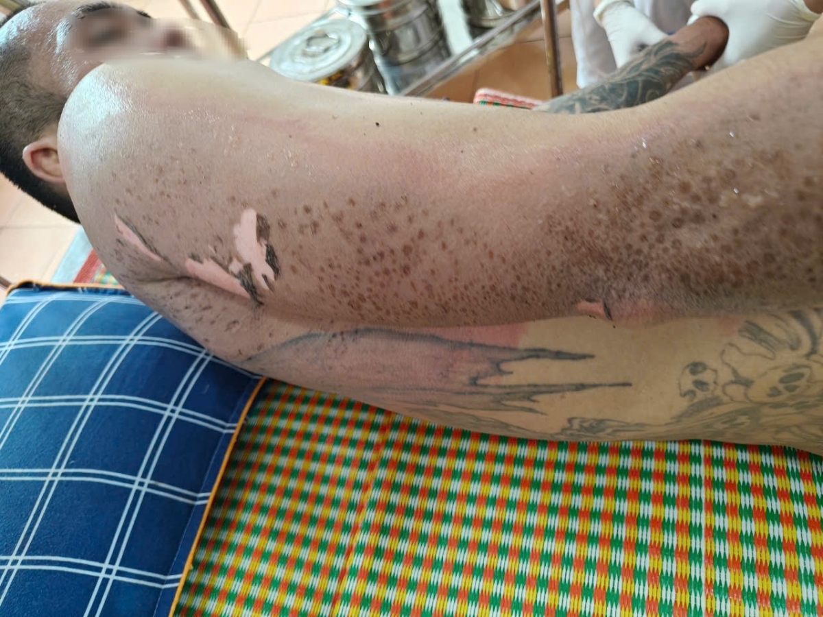 Vết bỏng nặng do điện giật trên cơ thể Hoàng Văn B