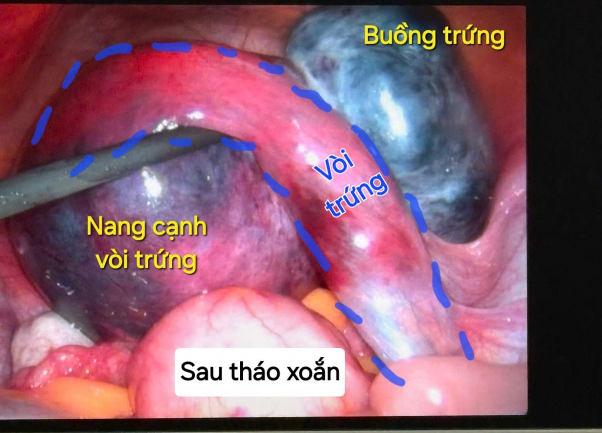 Hình ảnh khối xoắn gồm buồng trứng, vòi trứng, nang cạnh vòi trứng qua nội soi ổ bụng
 