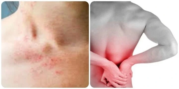 Da bị phát ban và đau lưng là những dấu hiệu cảnh báo suy thận nhẹ