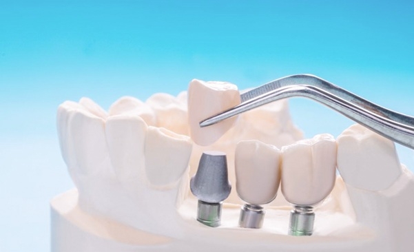 Implant áp dụng cho người đang có nhu cầu cải thiện trồng răng thẩm mỹ