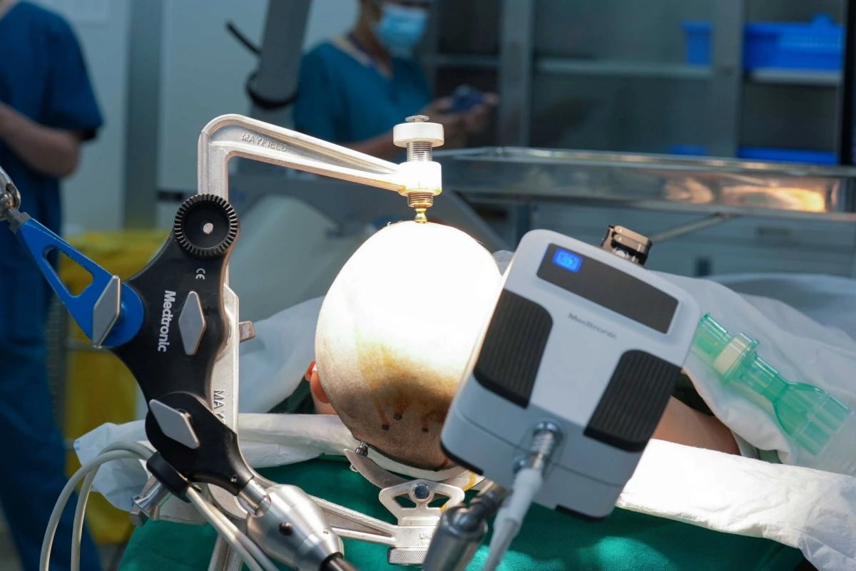 Cánh tay Robot AutoGuide giúp bác sĩ đặt điện cực vào nội sọ được chính xác và nhanh chóng