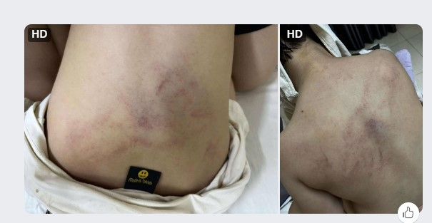 Hình ảnh cháu bé nghi bị giáo viên bạo hành