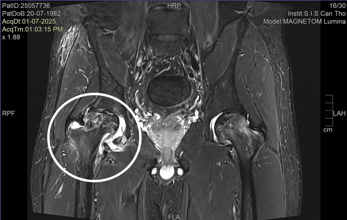 Hình ảnh MRI ghi nhận hình ảnh bị hoại tử chỏm xương đùi