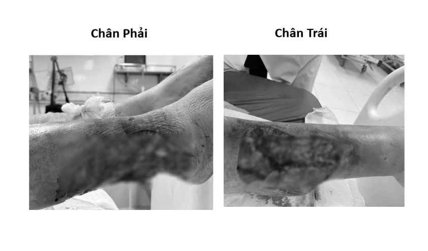 Vết thương có nguy cơ hoại tử sau tai nạn giao thông