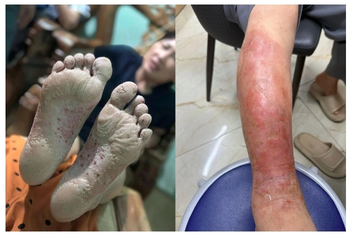 Các bệnh về da xuất hiện sau mưa bão, lũ lụt (ảnh BSCC)