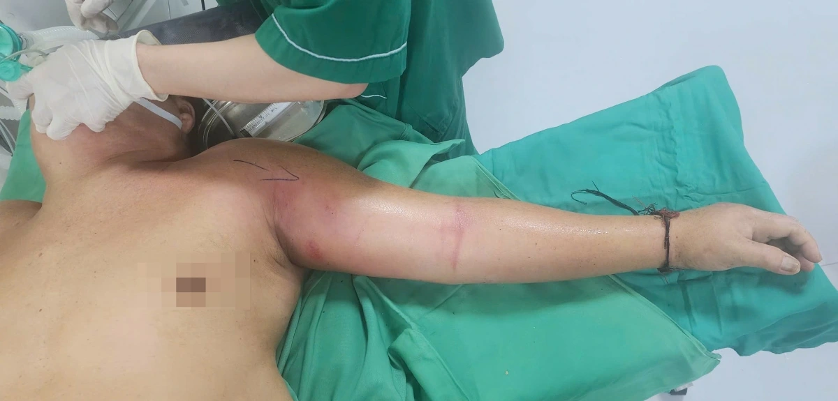 Bệnh nhân nhập viện trong tình trạng đau sưng toàn bộ tay trái do tự tiêm mật gấu để chữa đau ngực