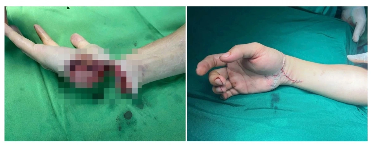 Bàn tay của nam Tiktoker trước và sau khi được phẫu thuật. Ảnh: BSCC