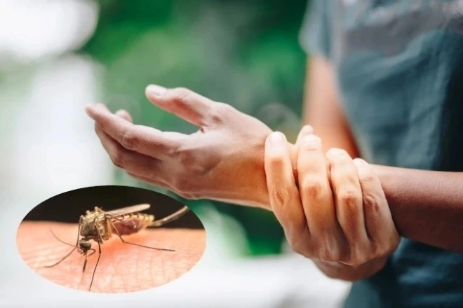 Bệnh Chikungunya dễ bị nhầm sang bệnh khác vì có biểu hiện tương tự sốt xuất huyết và Zika. Ảnh: Fitme Physio