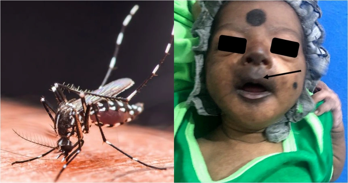 Bé sơ sinh mặt tím đen, phải nhập viện cấp cứu khẩn cấp vì Chikungunya. Ảnh: Clinical Case Reports