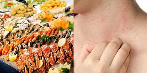 Người có cơ địa dị ứng cần cẩn trọng khi ăn hải sản