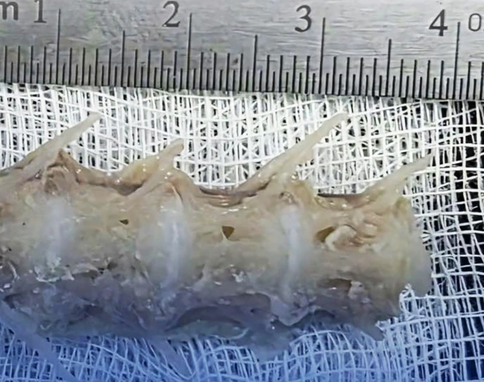 Đoạn xương cá dài 4 cm gắp ra từ cổ họng cụ ông