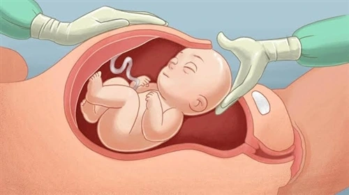 Mổ chủ động là hạn chế những trường hợp cấp cứu xảy ra, làm người bệnh lâm vào cảnh thập tử nhất sinh