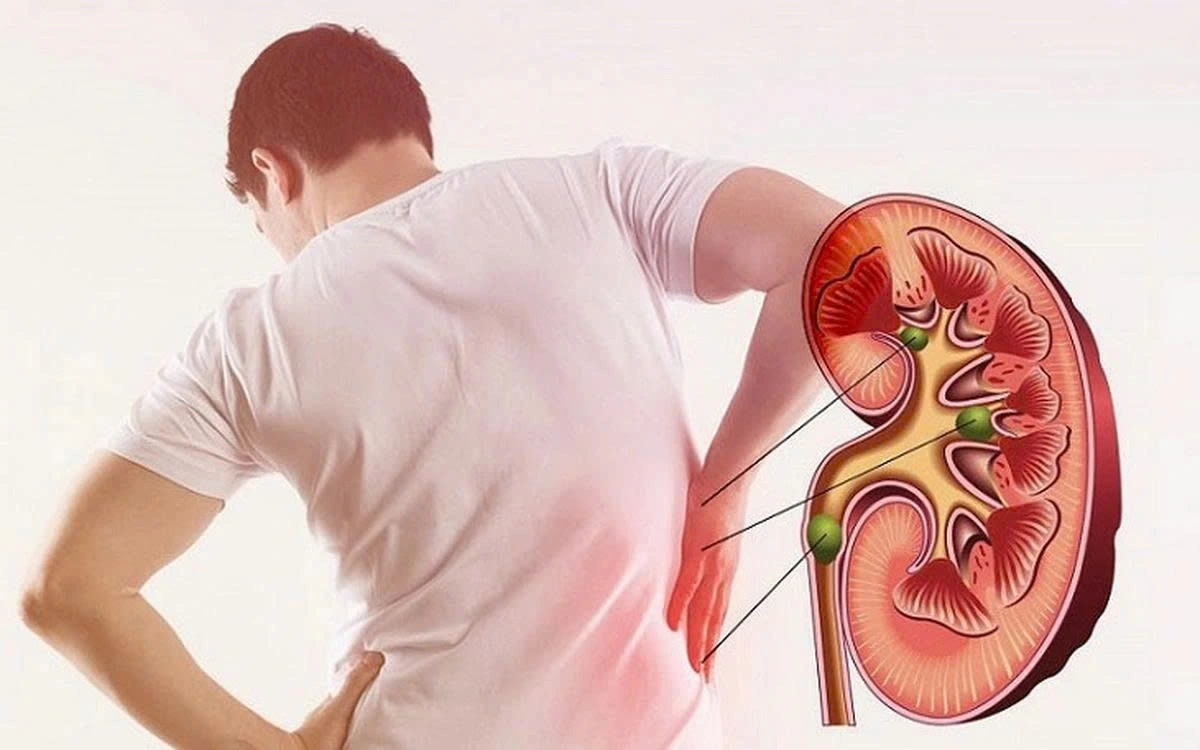 Người suy thận cần có chế độ dinh dưỡng hợp lý