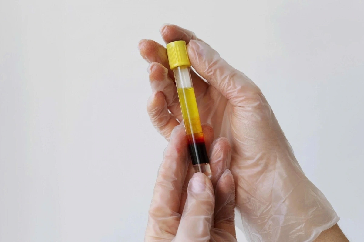 Máu nhiễm mỡ (hay mỡ máu cao) là tình trạng rối loạn chuyển hóa lipid trong máu. Ảnh: Freepik