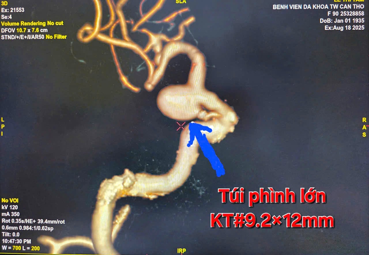 Hình ảnh túi phình kích thước lớn trên DSA