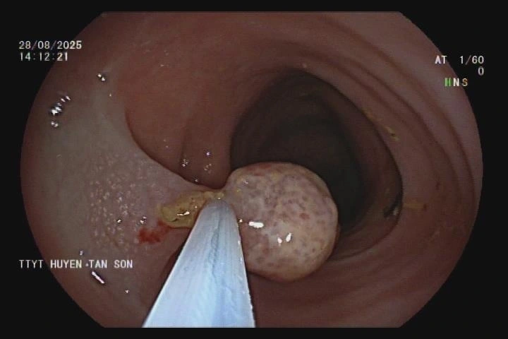 Hình ảnh polyp đại tràng của bệnh nhi. Ảnh: Trung tâm Y tế khu vực Tân Sơn