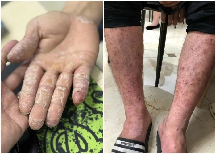 Sau bão, lũ lụt kéo dài tại nhiều địa phương tạo điều kiện cho vi khuẩn, nấm mốc phát triển, làm tăng nguy cơ bùng phát các bệnh ngoài da (Ảnh: BSCC)