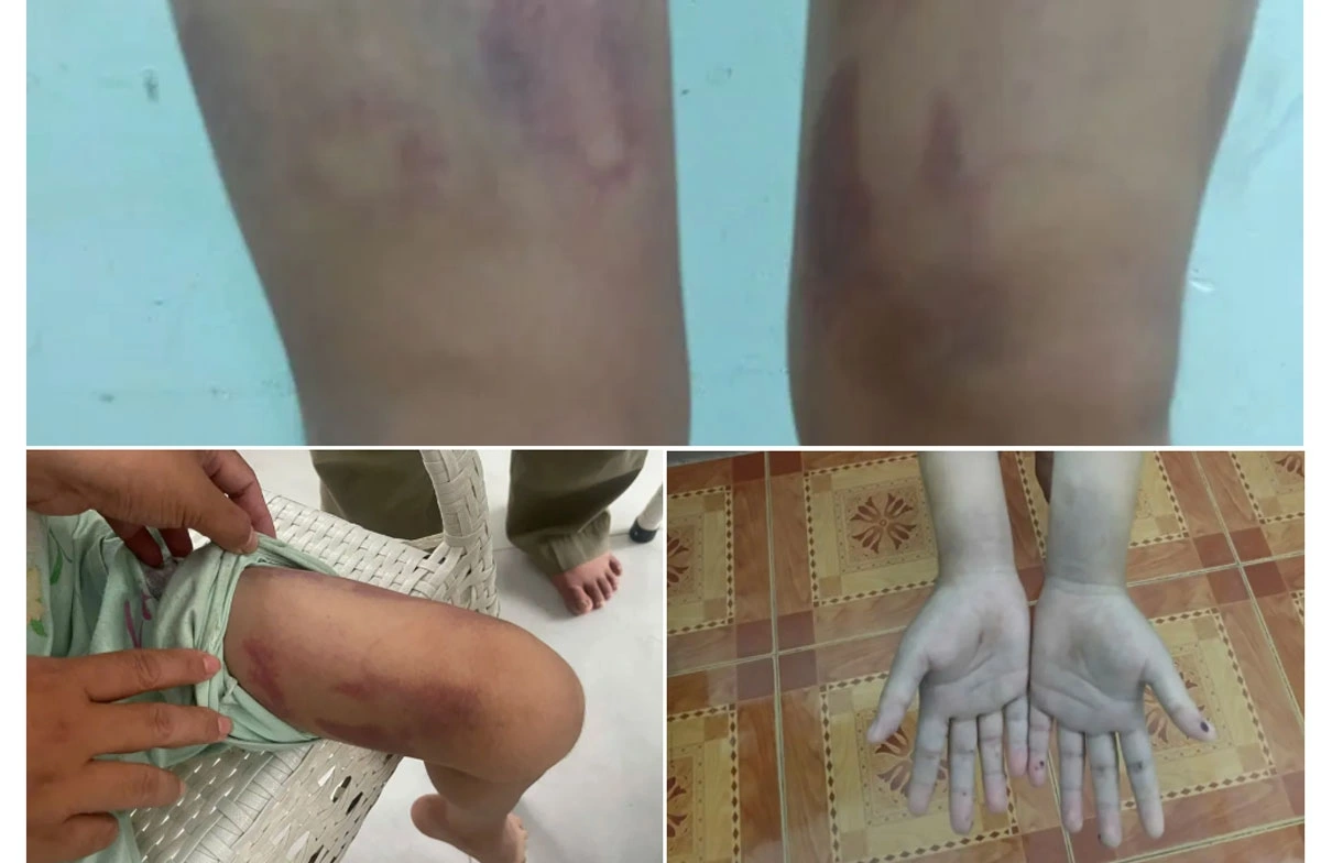 Ảnh bé bị bạo hành