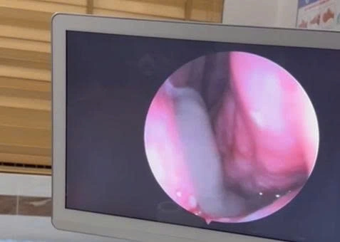 Hình ảnh nội soi con đỉa trong khoang mũi người đàn ông (ảnh TTYT cung cấp)