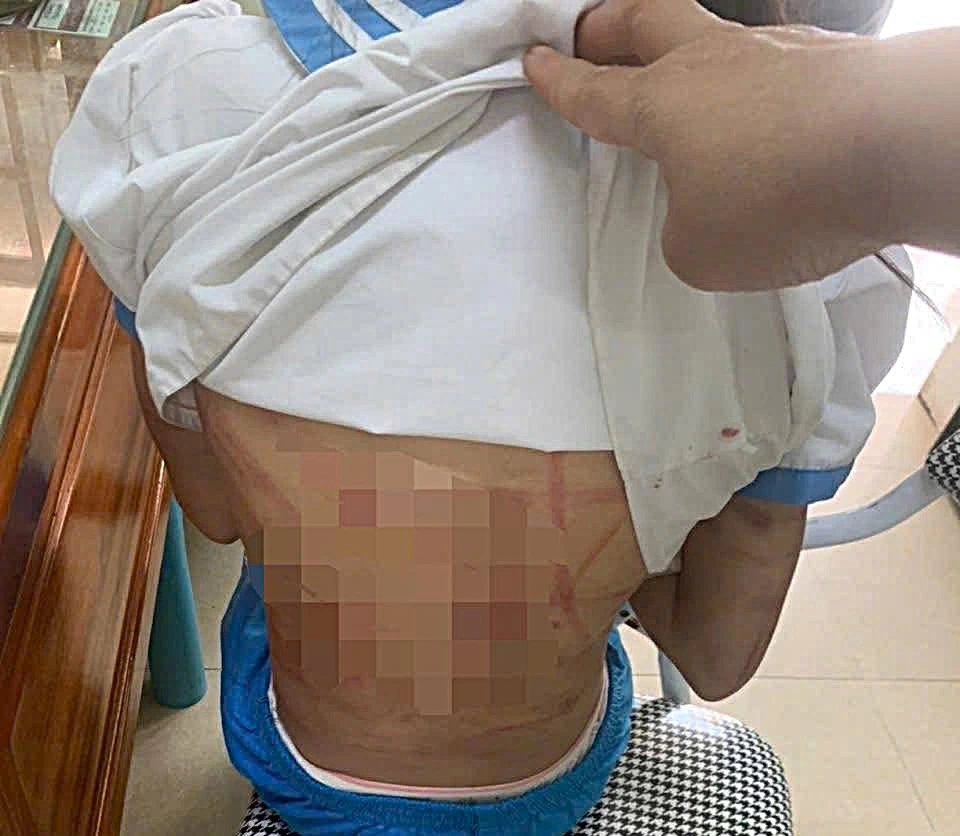 Cháu H.T.N.L. với chi chít vết thương trên người.