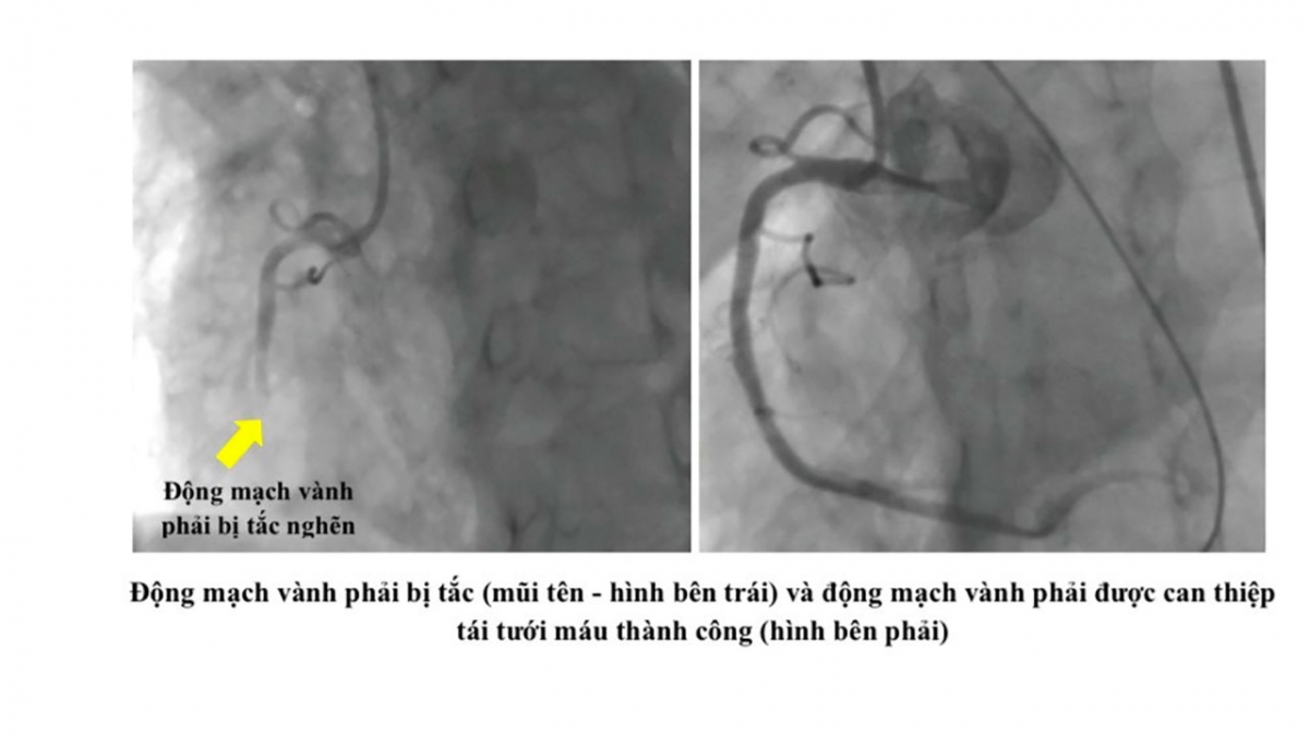 Động mạch vành phải của bệnh nhân bị tắc và sau khi được can thiệp (Ảnh Sở Y tế TP.HCM)