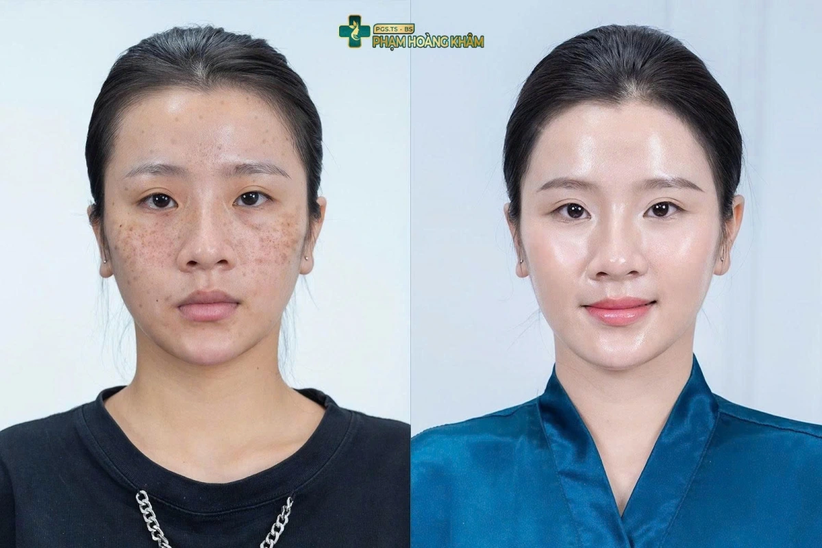 Hình ảnh khách hàng trước và sau khi điều trị bằng Công nghệ Picosure tại PGS.TS Phạm Hoàng Khâm
