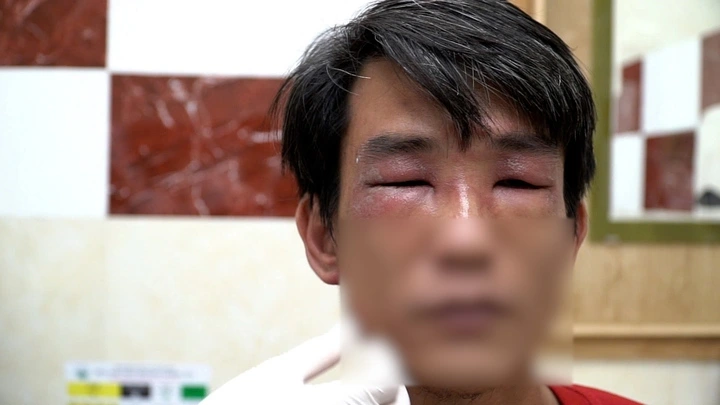 Dịch độc từ kiến ba khoang có thể gây ra những vết thương lan rộng, đau rát.