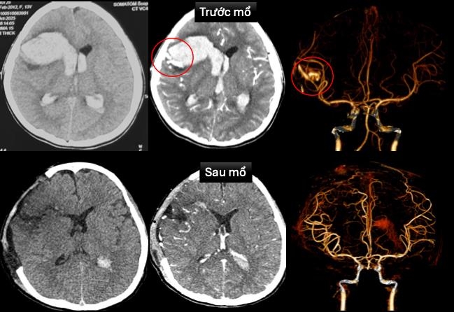 Hình ảnh chụp cắt lớp vi tính sọ não và dựng hình mạch máu não trước và sau mổ 