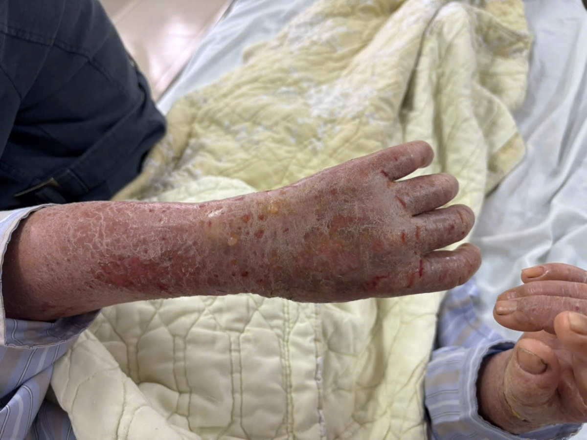 Bệnh nhân nhập viện trong tình trạng da bong vảy, sẩn ngứa toàn thân, ngứa nhiều kèm sốt nhẹ. (Ảnh: BVCC)